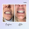 Keeko Shine Bright Teeth Whitening Set