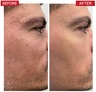 Dr. Levy Switzerland Deep Renewal Cure with Microneedling